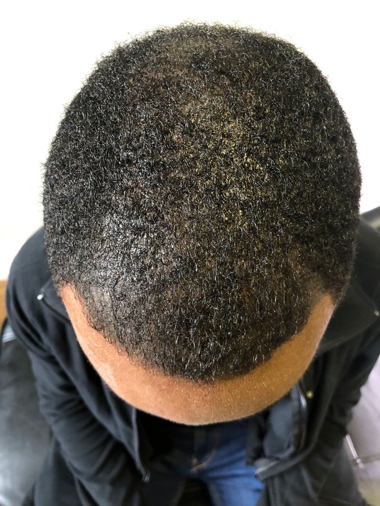 Cabeza después de un tratamiento de redensificación capilar