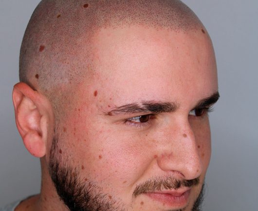 Cabeza masculina después de tratamiento micropigmentación capilar