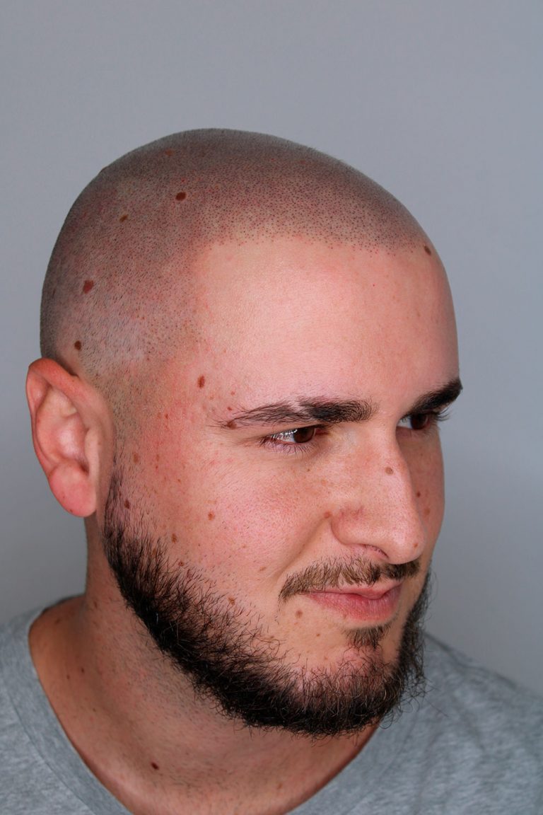 Cabeza masculina después de tratamiento micropigmentación capilar