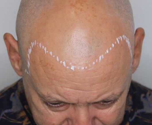 Cabeza masculina marcada para tratamiento micropigmentación capilar