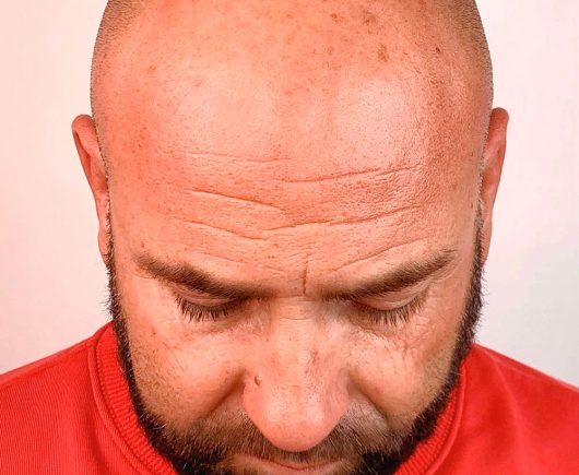 Cabeza masculina antes de un tratamiento de micropigmentación capilar