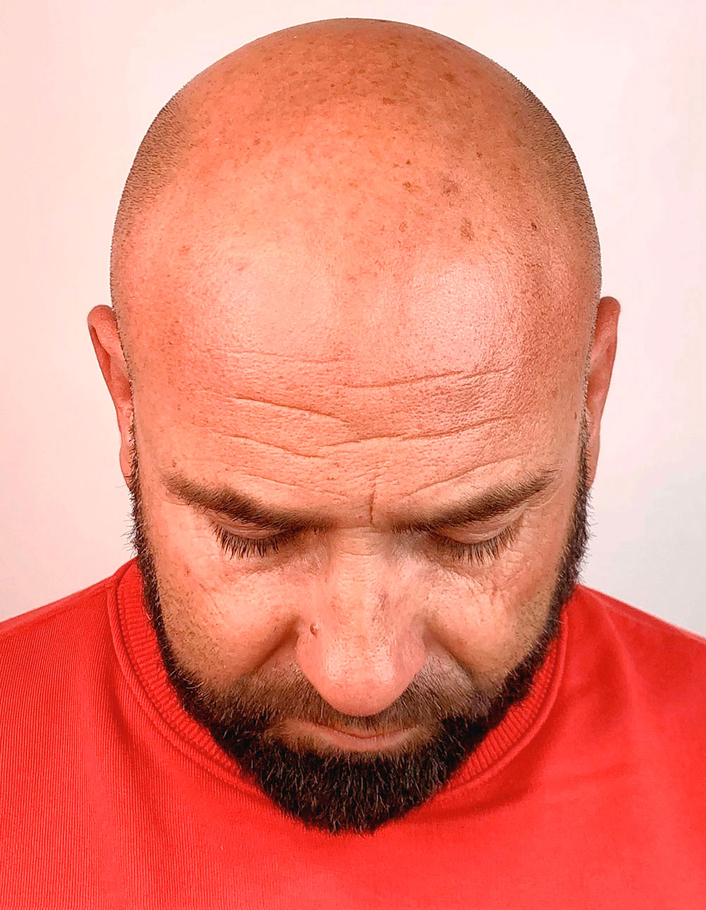 Cabeza masculina antes de un tratamiento de micropigmentación capilar